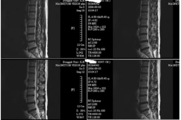 Fig. 1.  L-spine axial view of case 1 MRI. Fig. 2.  L-spine sagittal view of case 1 MRI.