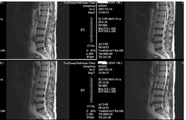 Fig. 3.  L-spine sagittal view of case 2 MRI.