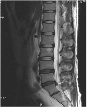 Fig. 6.  L-spine sagittal view of case 3 MRI.