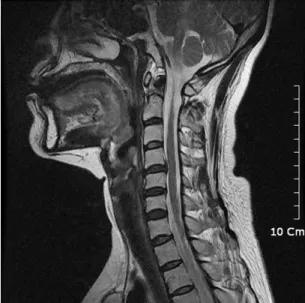 Fig. 1.  C-spine MRI(Sagittal view).