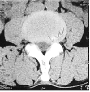 Fig. 2.  L-spine CT. Axial view of L4-5. On 8 August, 2006.