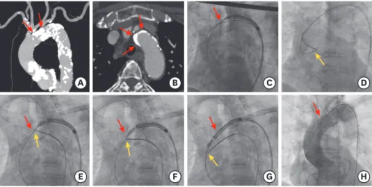 Figure 1. Snare-assisted delivery of a self-expanding valve. 
