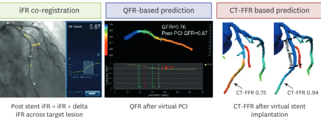 Figure 5. Novel modalities to predict post-PCI physiologic status before stent implantation