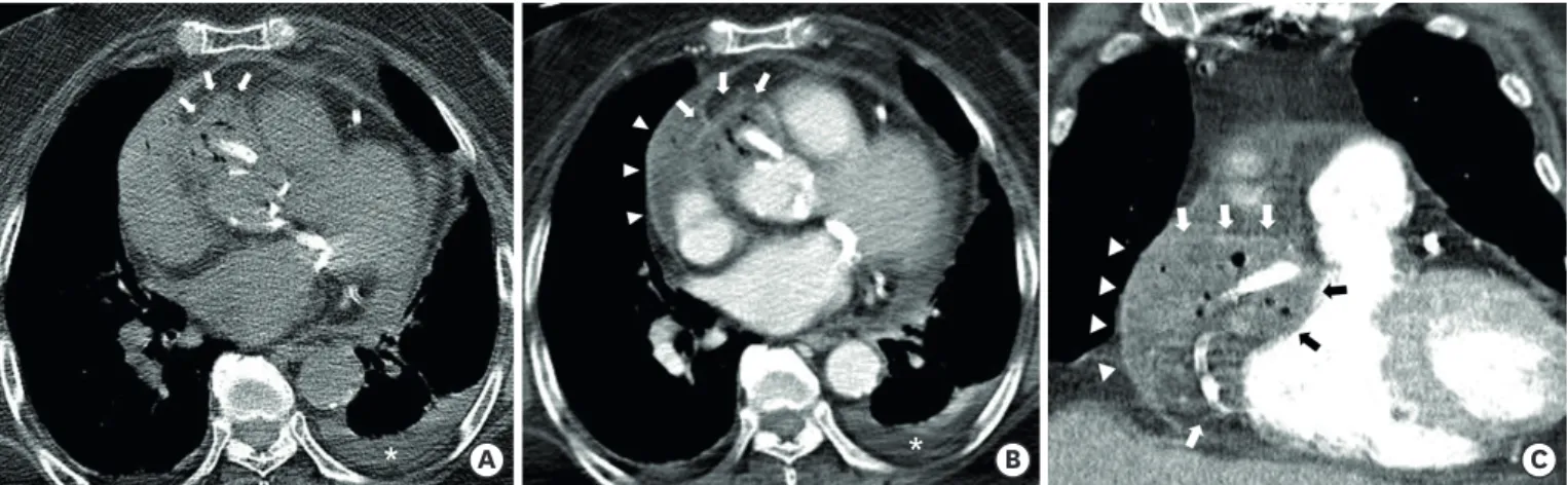 Figure 2. Chest CT images. (A) An air containing mass with high attenuation is noted on preconstrast CT around the proximal right coronary artery stent and  along the right atrioventricular groove at the aortic sinus level (white arrows)
