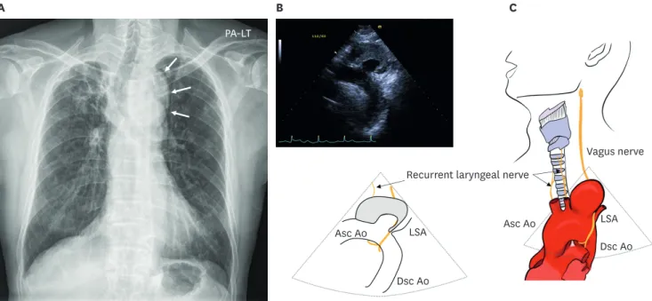 Figure 1. Chest X-ray shows an abnormally round shadow above the aortic knob (A, arrows) and rightward deviation of the trachea