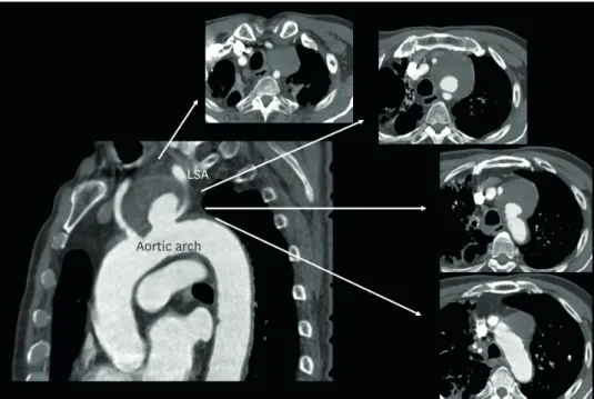 Figure 2. Contrast-enahced computerized tomography demonstrates about 65×60 mm sized large saccular  aneurysm on the aortic arch filled with mural thrombus near the origin of left subclavian artery