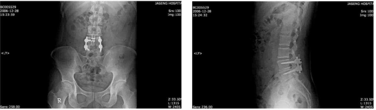 Fig. 1.  L-spine X-ray at 2006-12-28. Fig. 2.  L-spine X-ray at 2006-12-28.