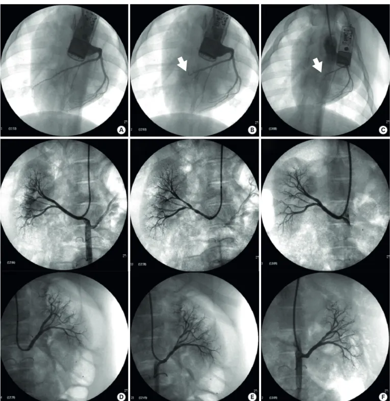 Figure 2. Coronary angiogram and renal artery angiogram. (A) Coronary angiogram, baseline