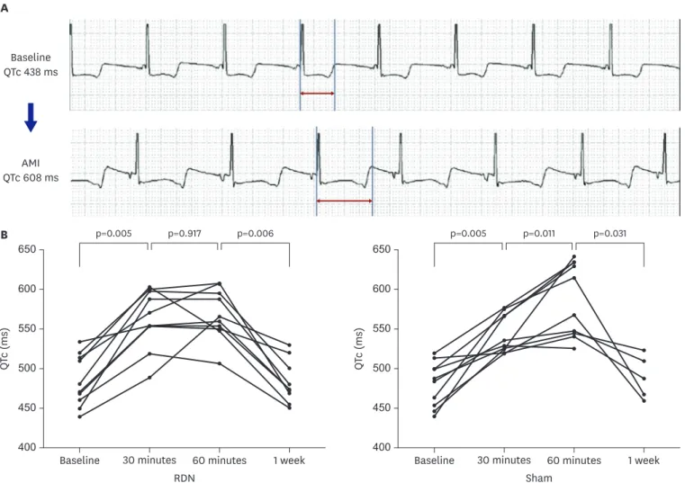 Figure 4. (A) A representative electrogram complex from a heart undergoing occlusion of the middle left anterior descending artery is shown