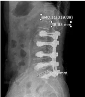 Fig. 1.  Before spinal fusion L-spine X-ray (2010.07.13). 