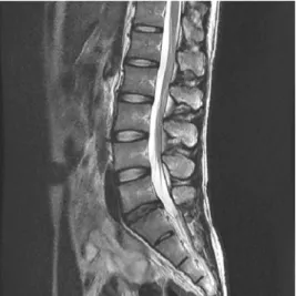 Fig. 1.  MRI of lumbar spine. Sagittal view.