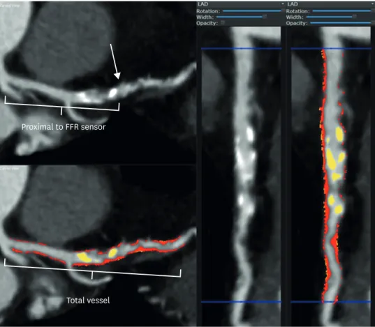 Figure 7. Quantitative plaque analysis. Left anterior descending artery. A region of interest was placed in the  ascending aorta at the level of the left main coronary artery, and scan-specific thresholds for calcified plaque  (yellow) and noncalcified pla