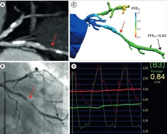Figure 1. Stenosis without ischemia. (A) Coronary computed tomography angiography with stenosis graded 