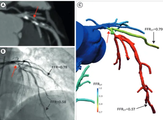 Figure 2. Stenosis with ischemia. (A) Lesion graded with &gt;50% stenosis in the proximal LAD on multiplanar  reformat of coronary computed tomography angiography (arrow)