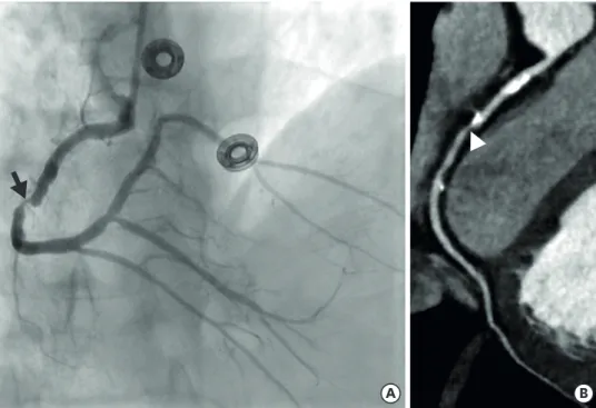 Figure 3. Direct plaque assessment. (A) Invasive coronary angiography, catheterization of the RCA