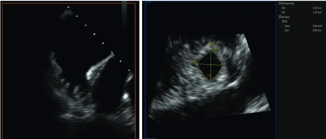 Figure 1. TEE at 135 o  shows a multilobed LAA with small thrombus in superior lobe (left)