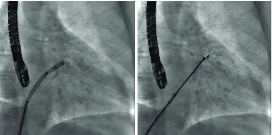 Figure 3. Partial delivery of umbrella component (left). Concave shape of the LAmbre's cover at the LAA  entrance (right)