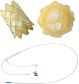 Figure 1. Melody valve. A modified bovine giugular vein with valve segment sutured on Numed Platinum Iridium  stent; the stent can be crimped down to 6 mm, mounted on a BIB balloon and re-expanded up to 18, 20, and 22  mm