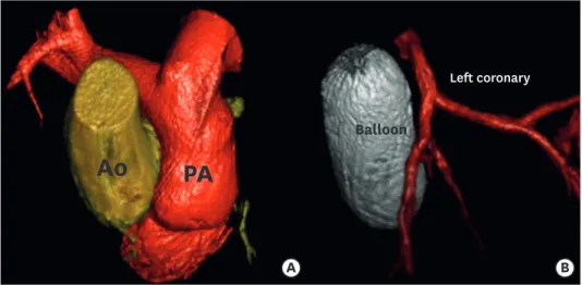 Figure 3. 3D rotational angiography and 3D Examples of reconstruction. (A) Ao and PA reconstruction