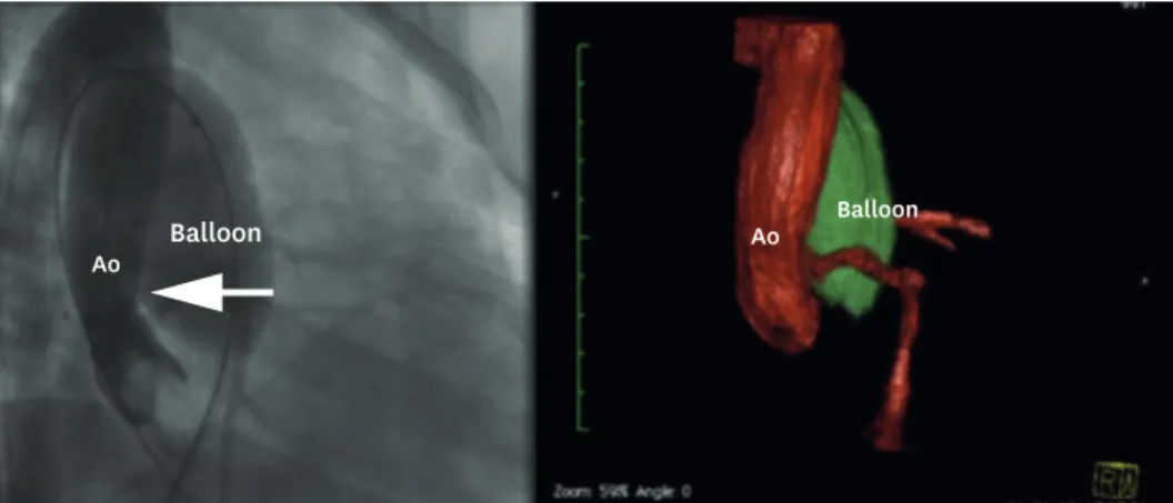 Figure 4. Balloon interrogation showing Ao root distorsion (arrow). 