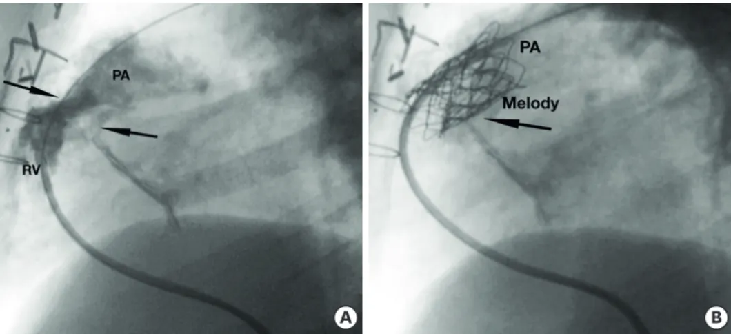 Figure 5. Balloon interrogation showing compression of the left coronary artery (arrow).