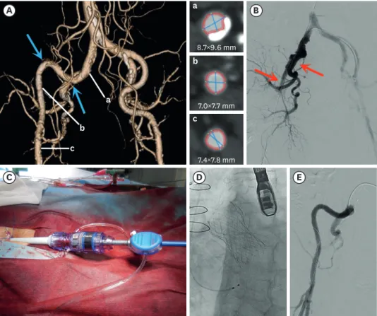 Figure 1. Computed tomographic, fluoroscopic, and intraprocedural images. (A) Pre-procedural multi-detector  computed tomography revealed good caliber (>7.0 mm) with little calcification (a-c), but severe tortuosity in  both external iliac arteries (blu