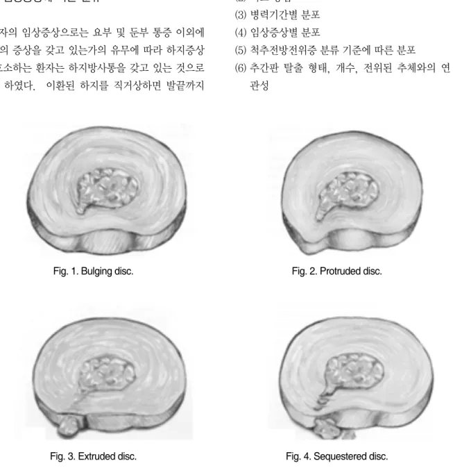 Fig. 1. Bulging disc. Fig. 2. Protruded disc.