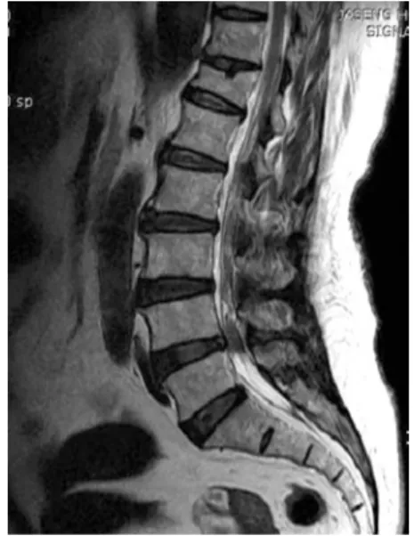 Fig. 2.  MRI of Lumbar spine at L4/5. axial view. T2 performed at 2006-07-03 