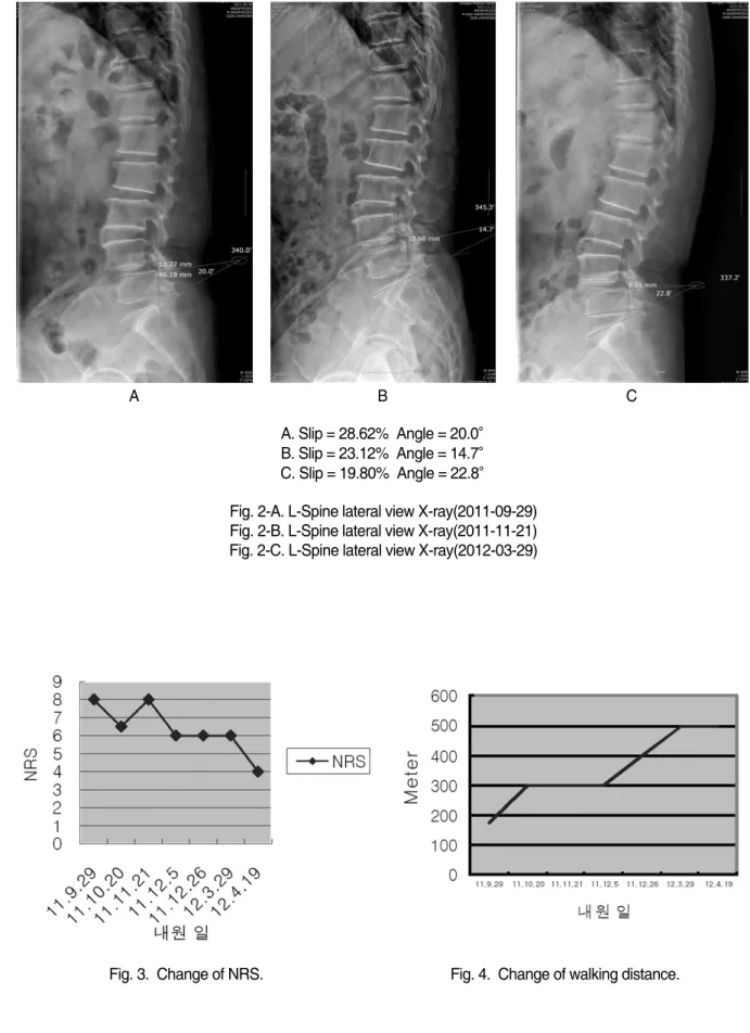 Fig. 3.  Change of NRS.    Fig. 4.  Change of walking distance.