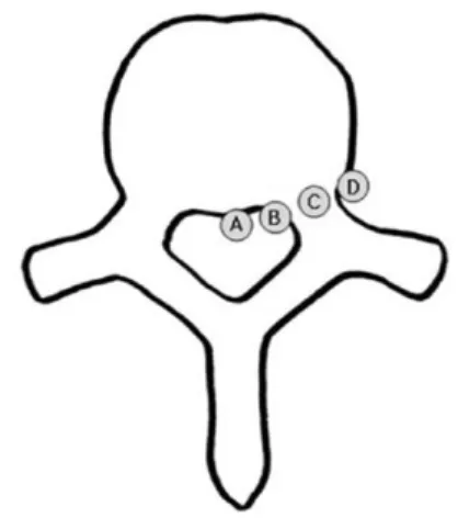 Fig. 1.  Classification of nerve compression.