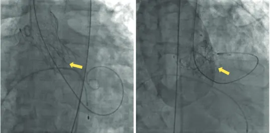 Figure 1. Infolding distortion of Evolut R valve strut (arrow).