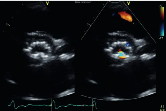 Figure 2. Serial echocardiography after 1 day post-TAVR revealed valve distortion (Left) with mild paravalvular  leakage (Right).