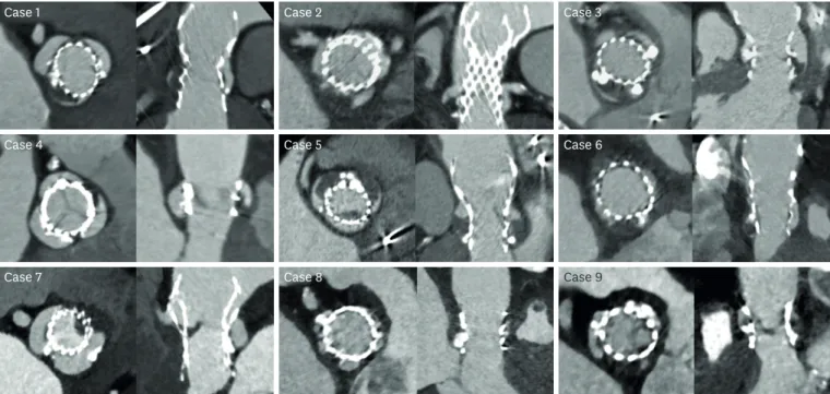 Figure 1. Multiplanar-reconstructed CT images of sinus of Valsalva thrombosis in the 8 patients
