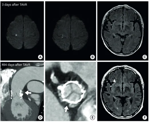 Figure 3. A 79-year-old woman who underwent TAVR. (A, B) Diffusion-weighted magnetic resonance images and (C) FLAIR image obtained 3 days after TAVR