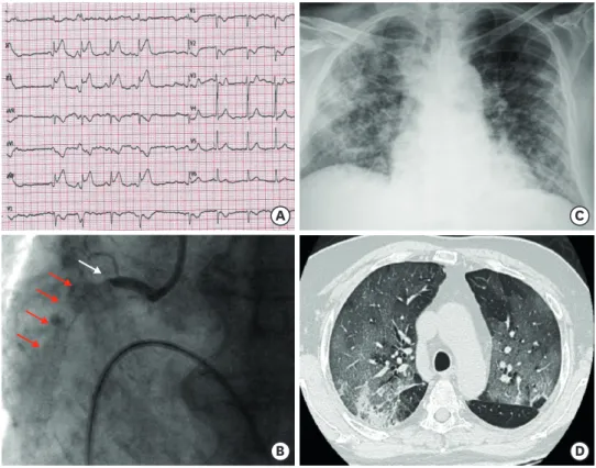 Figure 1. (A) Significant ST-segment elevation in inferior leads on electrocardiogram at presentation