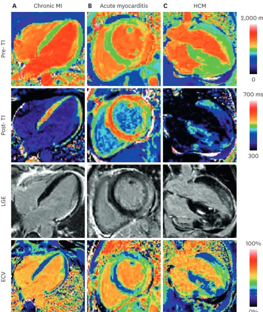 Figure 9. Examples illustrating excellent agreement between LGE and ECV in cases of focal abnormalities in  myocardial ECV