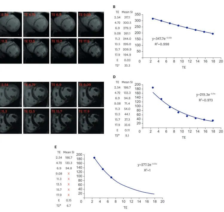 Figure 1. T2 *  imaging to assess myocardial iron overload. (A) T2 *  scan of a normal heart showing slow signal loss with increasing TE