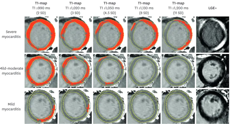 Figure 2. T1-maps using incremental thresholds demonstrate the predominantly non-ischemic pattern of injury across a spectrum of acute myocarditis