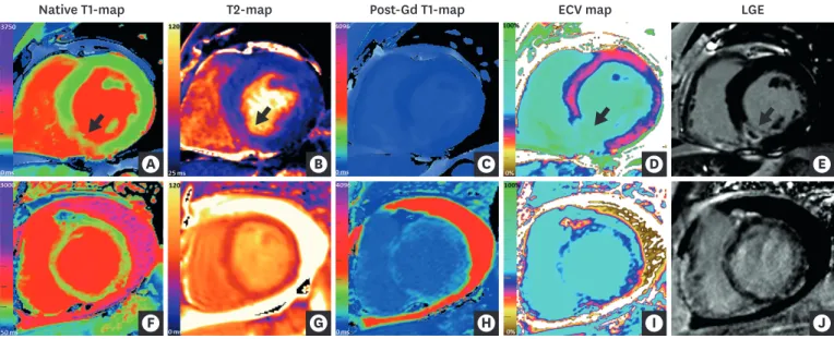 Figure 4. CMR mapping and LGE imaging in acute myocardial pathologies. (Top row) CMR (3 Tesla) images of a patient with an acute myocardial infarction in  the inferior septum
