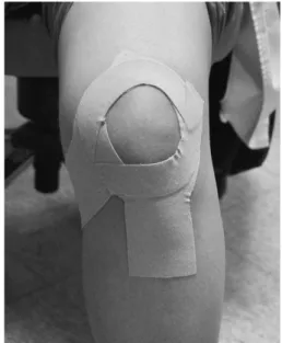 Fig. 1. Method of taping therapy in front of the knee.
