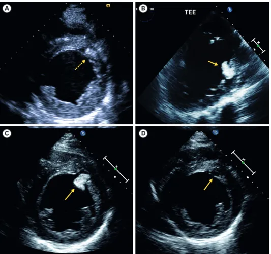 Figure 1. Echocardiographic images. (A) TTE demonstrates no visible embolic source in the LV
