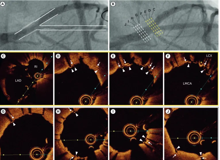 Figure 1. (A) The concept of culotte stenting (line with dots: 2 layers of struts). (B) Final coronary angiography after stenting using the culotte technique