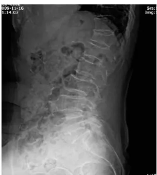 Fig. 2.  L-spine MRI(case1).