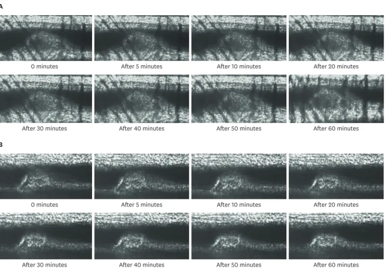 Figure 2. Representative images of spontaneous thrombolysis in the (A) placebo group and (B) dabigatran group.