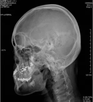 Fig. 7.  X-ray of Rt. TMJ (08.1.14)  