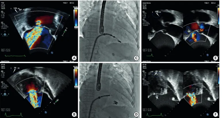 Figure 1. Severe MR demonstrated on (A, B) Pre-procedural transesophageal echocardiographic left ventricualar outflow tract and intercommissural view
