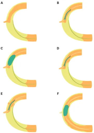 Figure 8. Schematic illustration of shifting reverse CART. (A) Navigation of a retrograde guidewire into the  subintimal space in a case of mid RCA CTO with a small side branch around the proximal cap