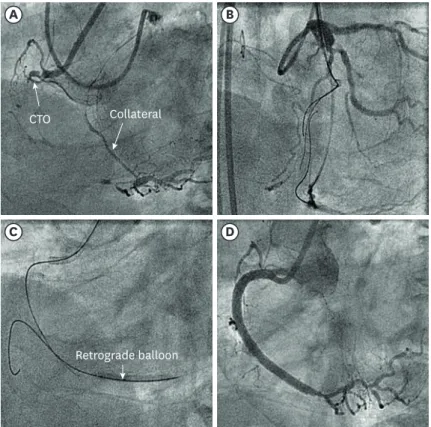 Figure 2. Depiction of CART technique in CTO. (A) A baseline coronary angiogram showing CTO of proximal RCA  with good epicardial collateral channel from LCX