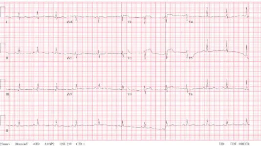 Figure 1. Twelve-lead electrocardiogram showing ST-segment elevations in leads V1-3 without reciprocal change.