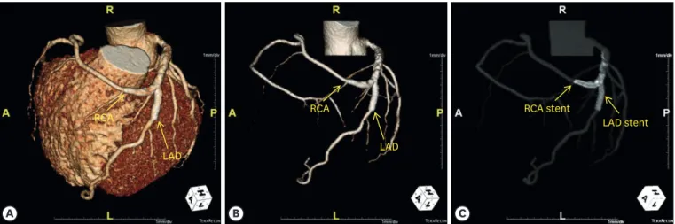 Figure 4. Three-dimensional computed tomography coronary angiographic images revealing an anomalous origin of the RCA from the LAD artery (A, B), and  showing patent stents at the bifurcation site between the LAD artery and the RCA (C)